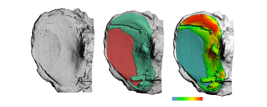 Visualising knee osteoarthritis